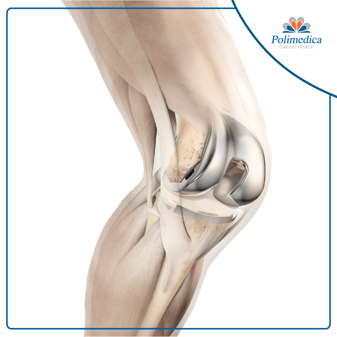 Rappresentazione grafica con logo di Polimedica Melfi, dell'anatomia di un ginocchio. Quando l’artrosi interessa il ginocchio, viene chiamata “gonartrosi”. Immagine di accompagnamento all'articolo dedicato alla gonartrosi.