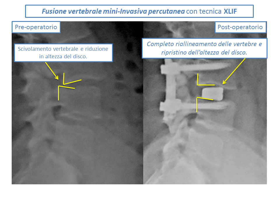 Immagine con una doppia radiografia: da un lato la spina dorsale prima di una operazione di Fusione vertebrale mini-invasiva percutanea; dall'altro la stessa colonna vertebrale successivamente all'intervento. Immagine di accompagnamento all'articolo Spondilolistesi degenerativa.