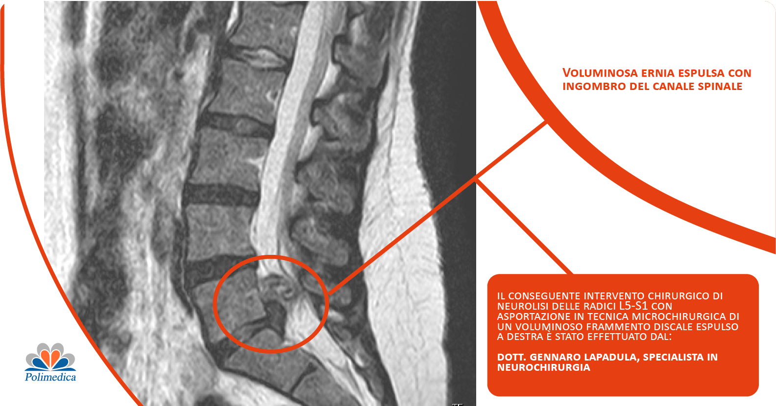 Immagine con logo di Polimedica Melfi, composta da una radiografia di una spina dorsale con ernia al disco e da un box descrittivo. Immagine di accompagnamento all'articolo dedicato alla riabilitazione dopo l’asportazione di un’ernia discale.