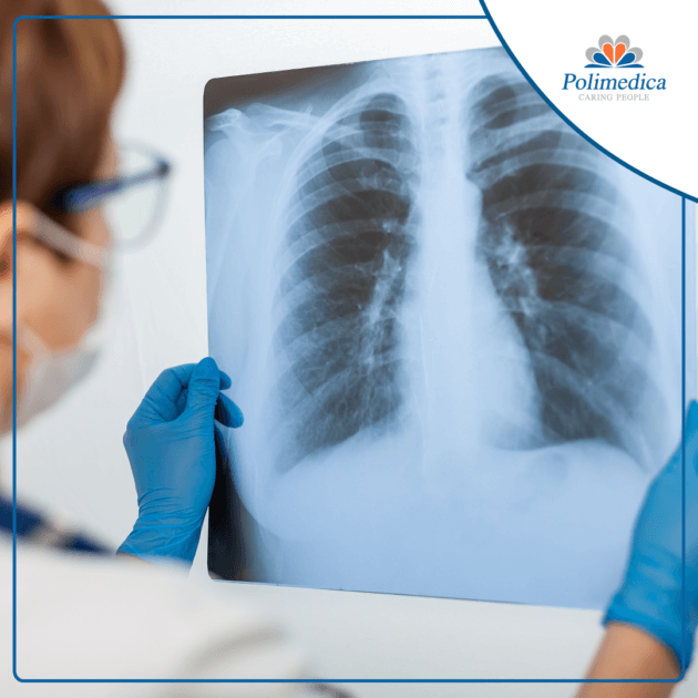 Foto, con logo di Polimedica Melfi, di un medico che esamina una radiografia ai polmoni. Immagine utilizzata per il post Offerta di lavoro per specialista in tisiologia.