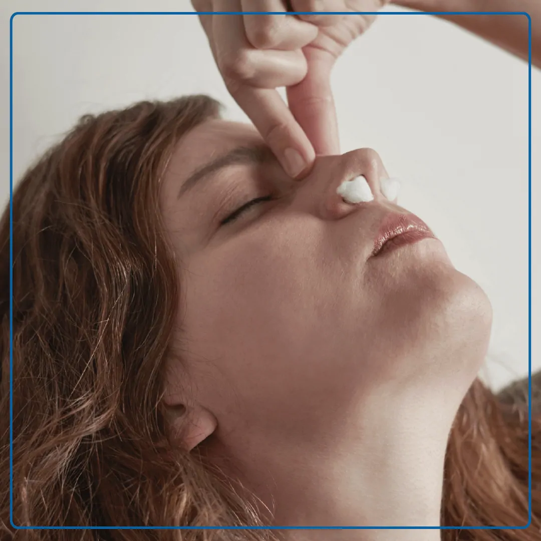 Foto di una donna con la testa verso l'alto che si tocca il naso con due tamponi di ovatta nelle narici. Immagine utilizzata per le pagine Controllo di epistassi mediante cauterizzazione; Controllo di epistassi mediante tamponamento nasale.